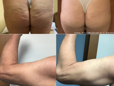 Keywellness-BeforeAfter-ButtArms-A